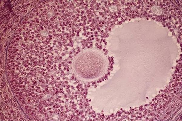 多囊患者卵泡较多、质量不行